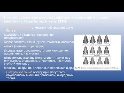 Патоморфологическая классификации аномалий носового клапана (Y. Casperbamer, Е.Кеrn, 1987). Интрамуральные аномалии (обструкции)