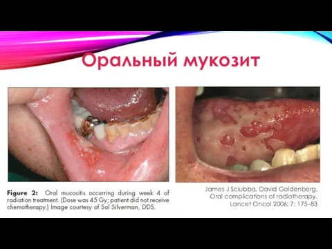 Оральный мукозит James J Sciubba, David Goldenberg. Oral complications of radiotherapy. Lancet Oncol 2006; 7: 175–83