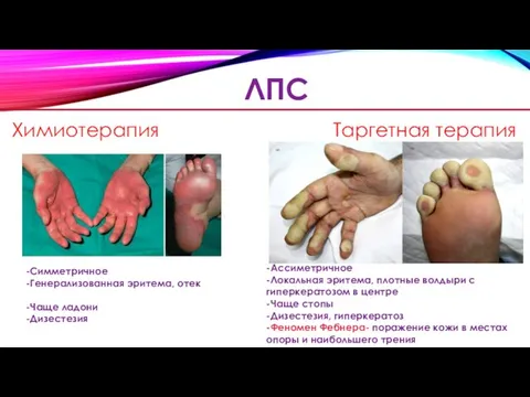 Таргетная терапия Химиотерапия ЛПС -Симметричное -Генерализованная эритема, отек -Чаще ладони -Дизестезия -Ассиметричное