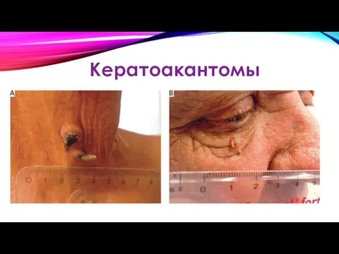 Кератоакантомы