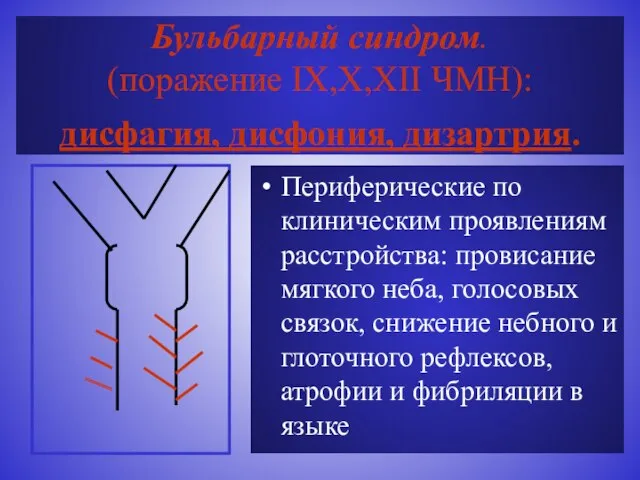 Бульбарный синдром. (поражение IX,X,XII ЧМН): дисфагия, дисфония, дизартрия. Периферические по клиническим проявлениям