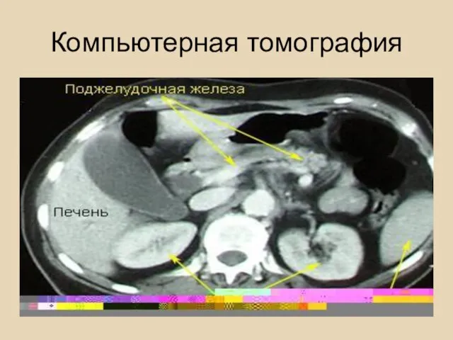 Компьютерная томография