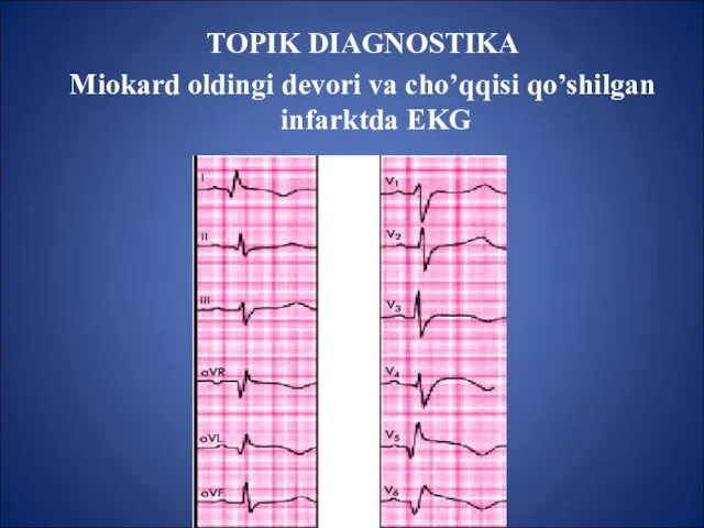 TOPIK DIAGNOSTIKA Miokard oldingi devori va cho’qqisi qo’shilgan infarktda EKG