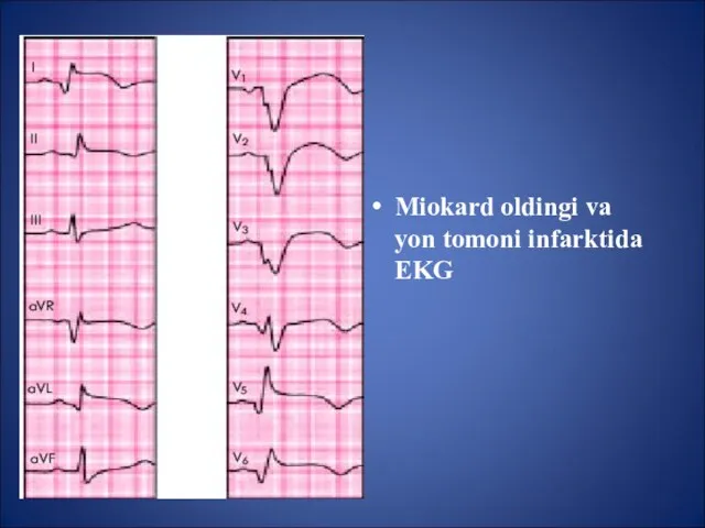 Miokard oldingi va yon tomoni infarktida EKG