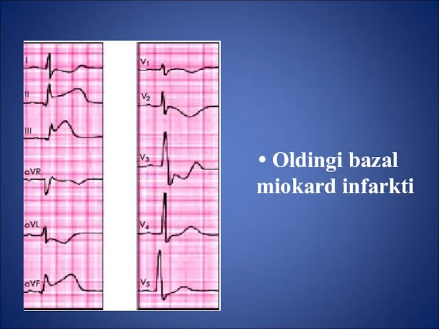 Oldingi bazal miokard infarkti