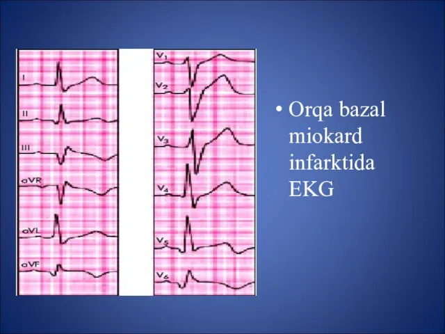 Orqa bazal miokard infarktida EKG