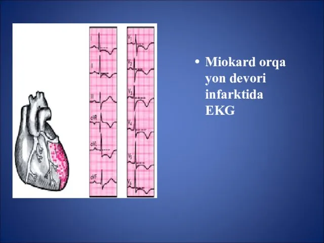 Miokard orqa yon devori infarktida EKG