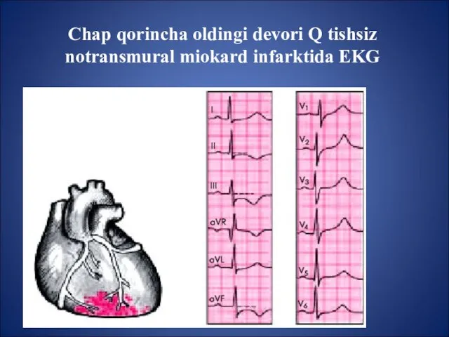 Chap qorincha oldingi devori Q tishsiz notransmural miokard infarktida EKG