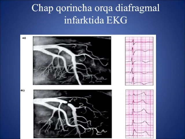 Chap qorincha orqa diafragmal infarktida EKG