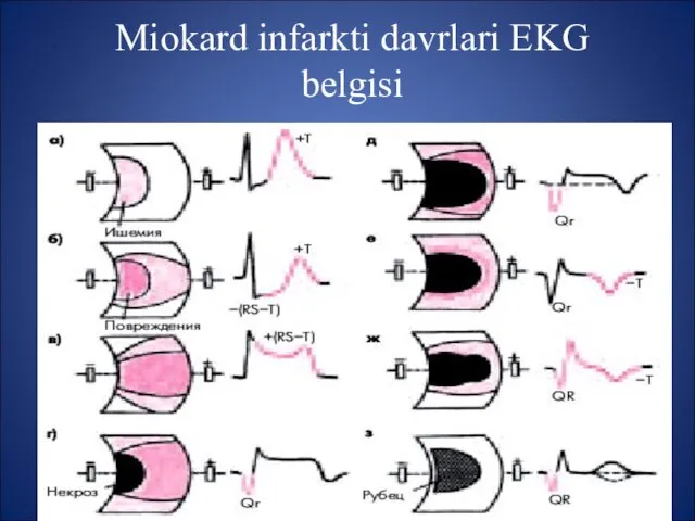 Miokard infarkti davrlari EKG belgisi