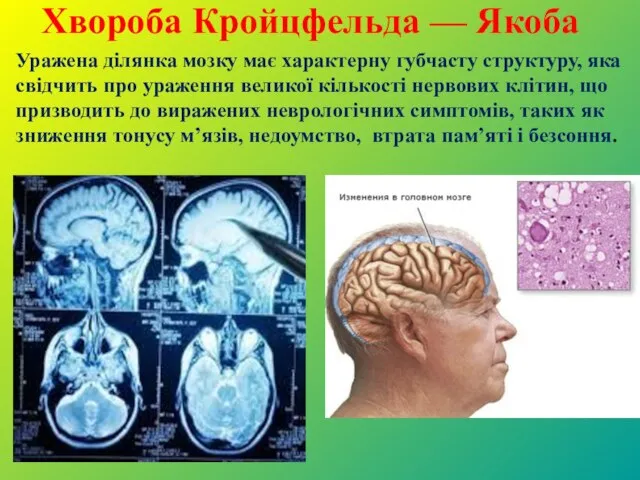 Хвороба Кройцфельда — Якоба Уражена ділянка мозку має характерну губчасту структуру, яка