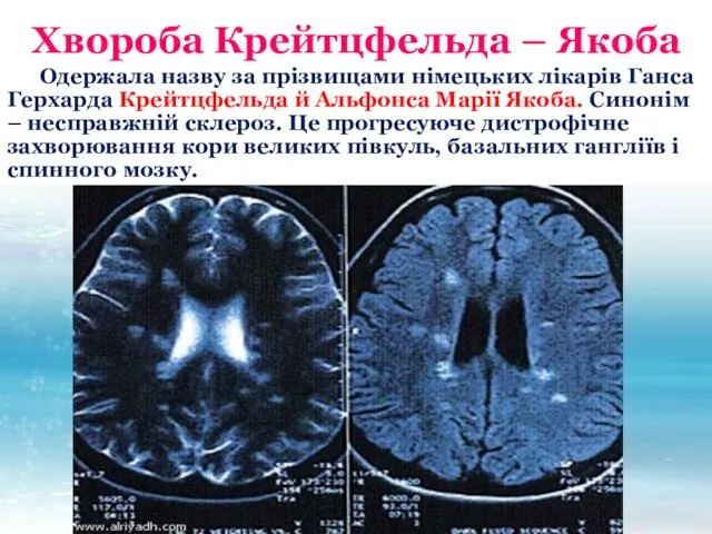 Хвороба Крейтцфельда – Якоба Одержала назву за прізвищами німецьких лікарів Ганса Герхарда