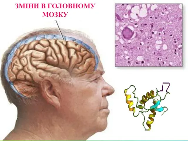 ЗМІНИ В ГОЛОВНОМУ МОЗКУ