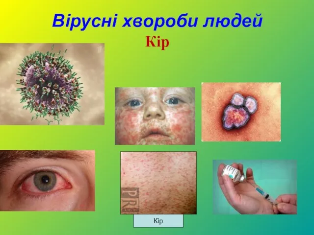 Вірусні хвороби людей Кір Кір