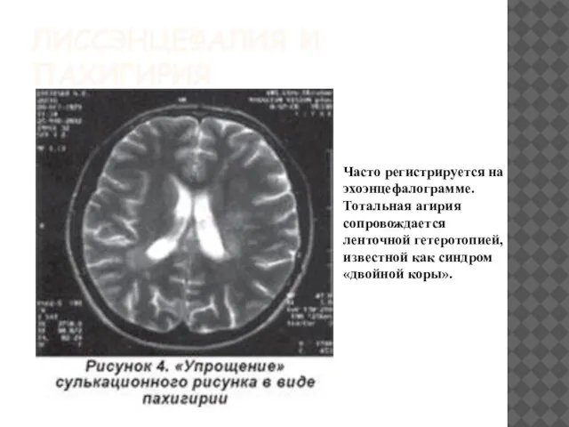 ЛИССЭНЦЕФАЛИЯ И ПАХИГИРИЯ Часто регистрируется на эхоэнцефалограмме. Тотальная агирия сопровождается ленточной гетеротопией,