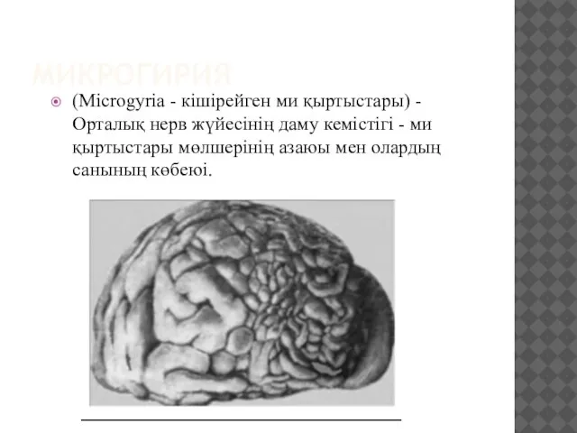 МИКРОГИРИЯ (Місrоgуrіа - кішірейген ми қыртыстары) - Орталық нерв жүйесінің даму кемістігі
