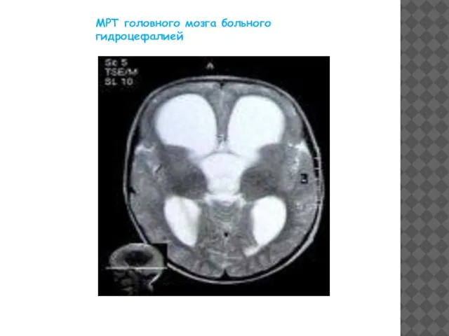 МРТ головного мозга больного гидроцефалией