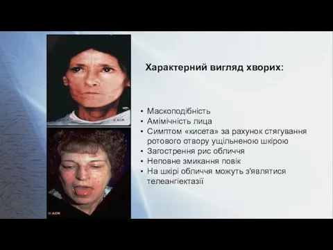 Характерний вигляд хворих: Маскоподібність Амімічність лица Симптом «кисета» за рахунок стягування ротового