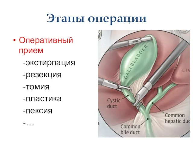 Этапы операции Оперативный прием -экстирпация -резекция -томия -пластика -пексия -…