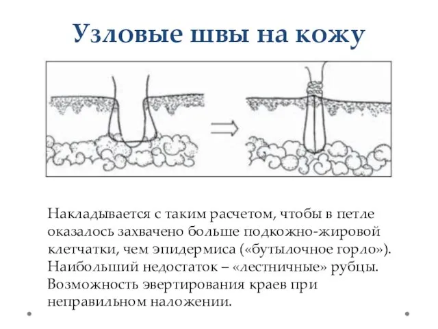 Узловые швы на кожу Накладывается с таким расчетом, чтобы в петле оказалось