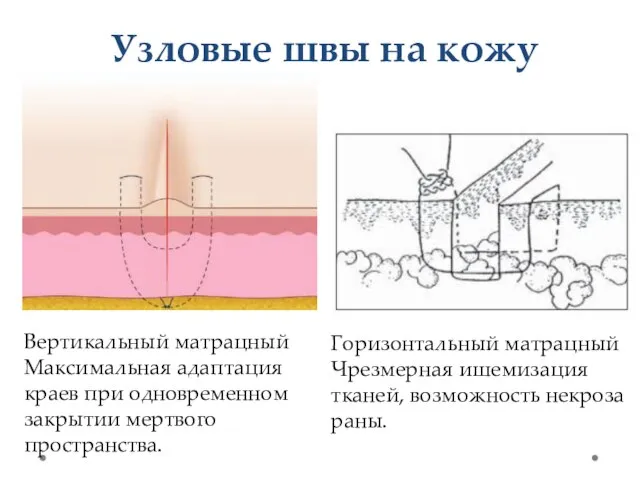 Узловые швы на кожу Вертикальный матрацный Максимальная адаптация краев при одновременном закрытии