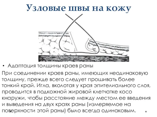 Узловые швы на кожу Адаптация толщины краев раны При соединении краев раны,