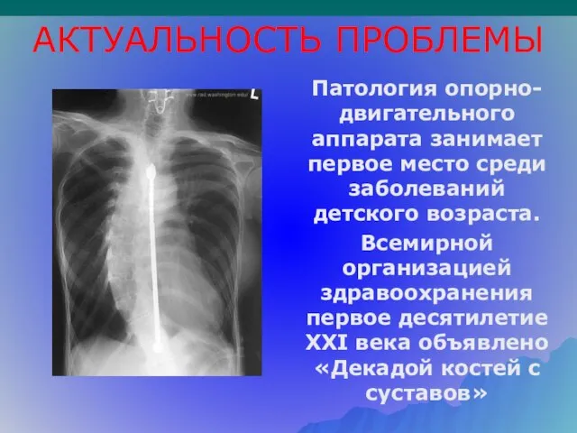 АКТУАЛЬНОСТЬ ПРОБЛЕМЫ Патология опорно-двигательного аппарата занимает первое место среди заболеваний детского возраста.