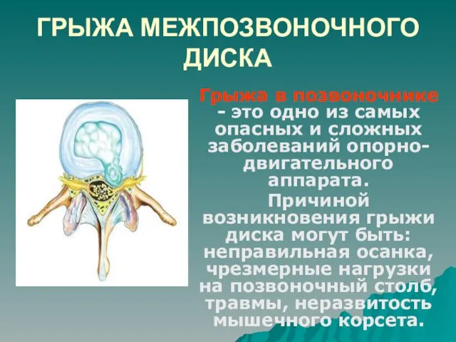 ГРЫЖА МЕЖПОЗВОНОЧНОГО ДИСКА Грыжа в позвоночнике - это одно из самых опасных