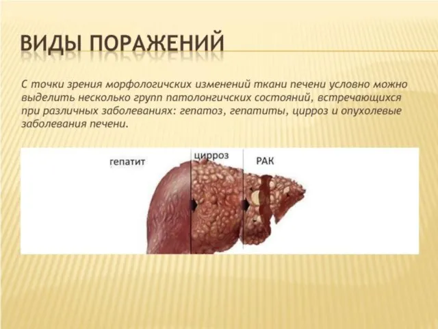 ВИДЫ ПОРАЖЕНИЙ C точки зрения морфологичских изменений ткани печени условно можно выделить