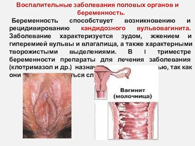 Воспалительные заболевания половых органов и беременность. Беременность способствует возникновению и рецидивированию кандидозного