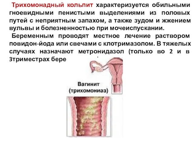 Трихомонадный кольпит характеризуется обильными гноевидными пенистыми выделениями из половых путей с неприятным