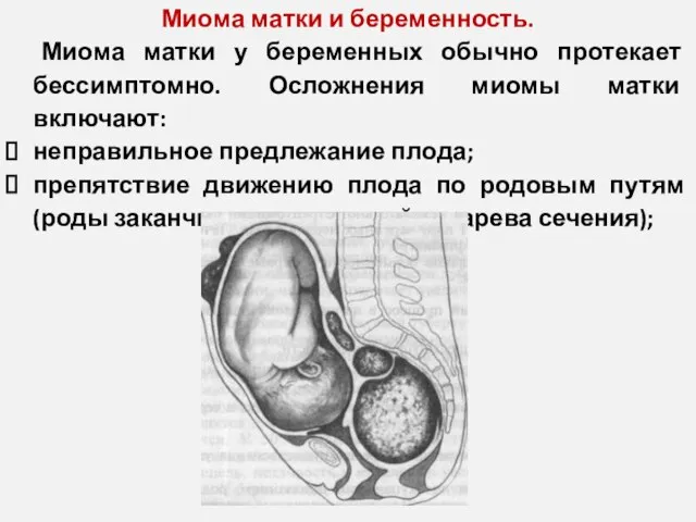 Миома матки и беременность. Миома матки у беременных обычно протекает бессимптомно. Осложнения