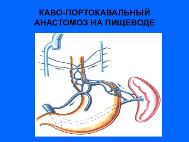 КАВО-ПОРТОКАВАЛЬНЫЙ АНАСТОМОЗ НА ПИЩЕВОДЕ