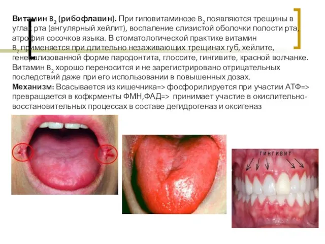 Витамин B2 (рибофлавин). При гиповитаминозе B2 появляются трещины в углах рта (ангулярный