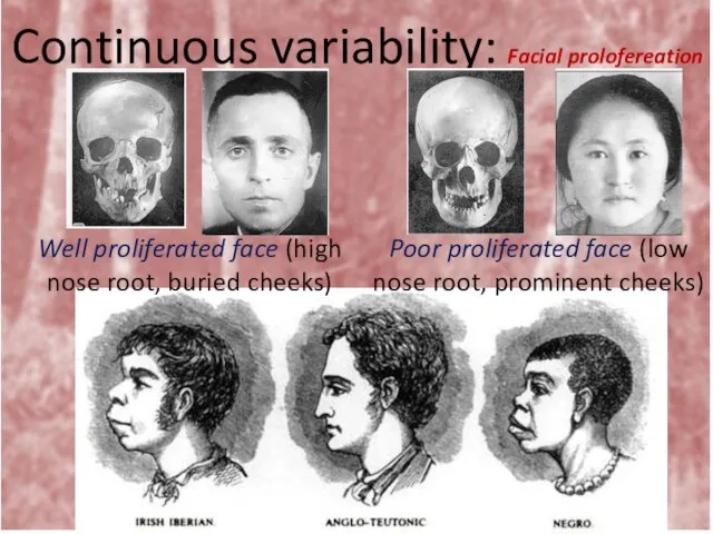 Continuous variability: Facial prolofereation Well proliferated face (high nose root, buried cheeks)