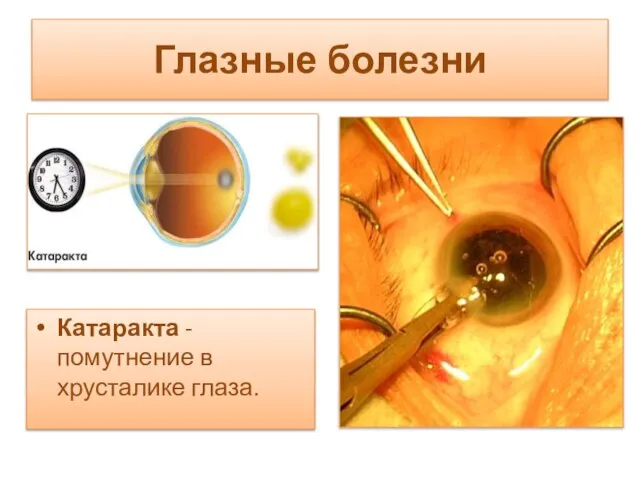 Глазные болезни Катаракта - помутнение в хрусталике глаза.