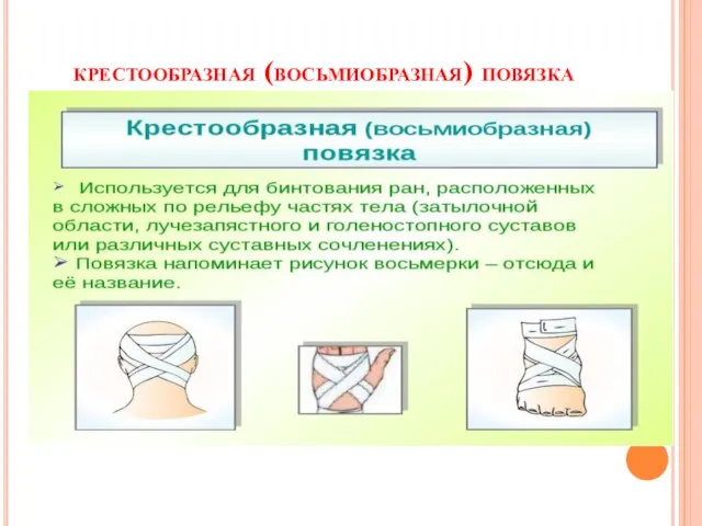 крестообразная (восьмиобразная) повязка