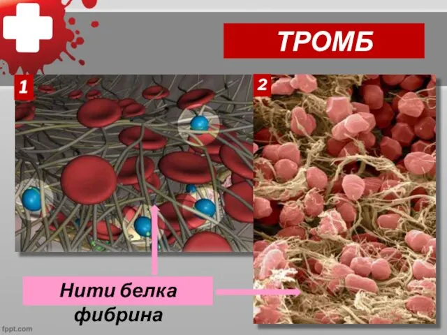 ТРОМБ Нити белка фибрина