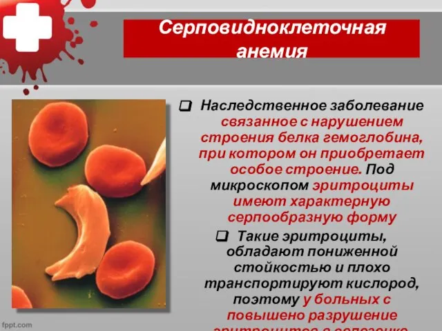 Серповидноклеточная анемия Наследственное заболевание связанное с нарушением строения белка гемоглобина, при котором