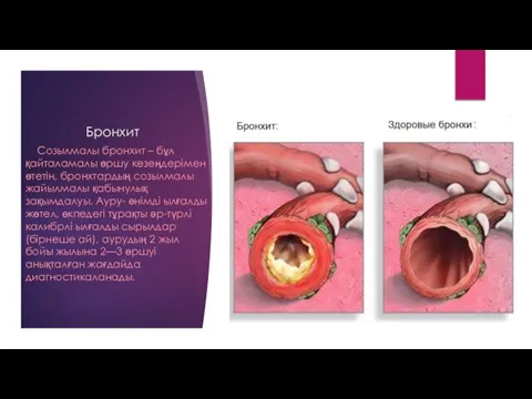 Бронхит Созылмалы бронхит – бұл қайталамалы өршу кезеңдерімен өтетін, бронхтардың созылмалы жайылмалы