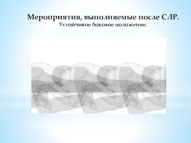 Мероприятия, выполняемые после СЛР. Устойчивое боковое положение.