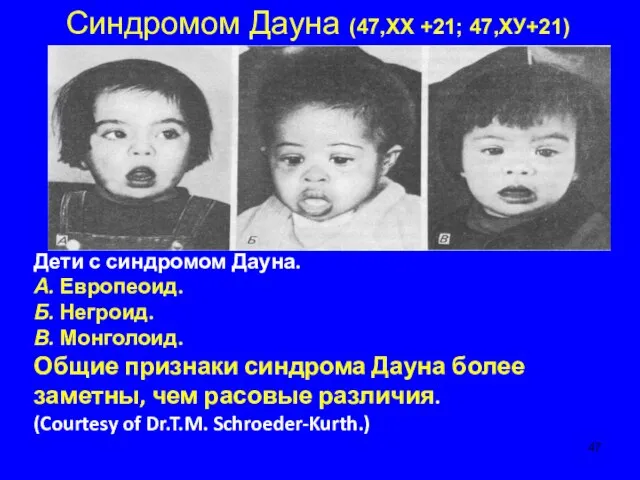 Синдромом Дауна (47,ХХ +21; 47,ХУ+21) Дети с синдромом Дауна. А. Европеоид. Б.