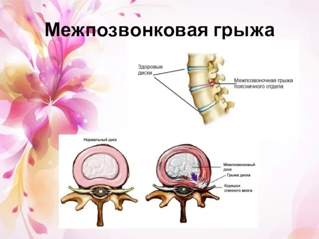 Межпозвонковая грыжа