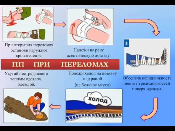 При открытых переломах останови наружное кровотечение. Обеспечь неподвижность места переломов костей поверх