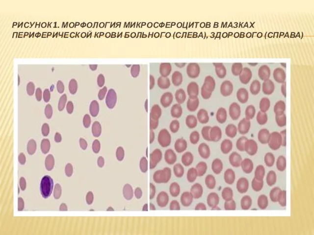 РИСУНОК 1. МОРФОЛОГИЯ МИКРОСФЕРОЦИТОВ В МАЗКАХ ПЕРИФЕРИЧЕСКОЙ КРОВИ БОЛЬНОГО (СЛЕВА), ЗДОРОВОГО (СПРАВА)