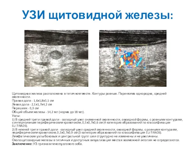 УЗИ щитовидной железы: Щитовидная железа расположена в типичном месте. Контуры ровные. Паренхима