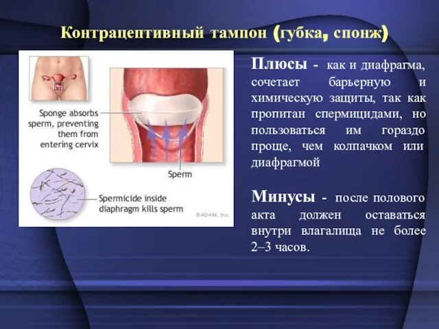 Контрацептивный тампон (губка, спонж) Плюсы - как и диафрагма, сочетает барьерную и