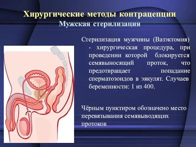 Хирургические методы контрацепции Мужская стерилизация Стерилизация мужчины (Вазэктомия) - хирургическая процедура, при