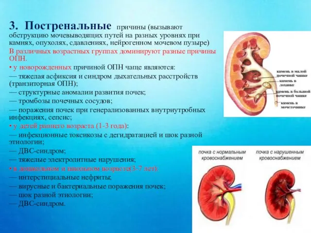 3. Постренальные причины (вызывают обструкцию мочевыводящих путей на разных уровнях при камнях,