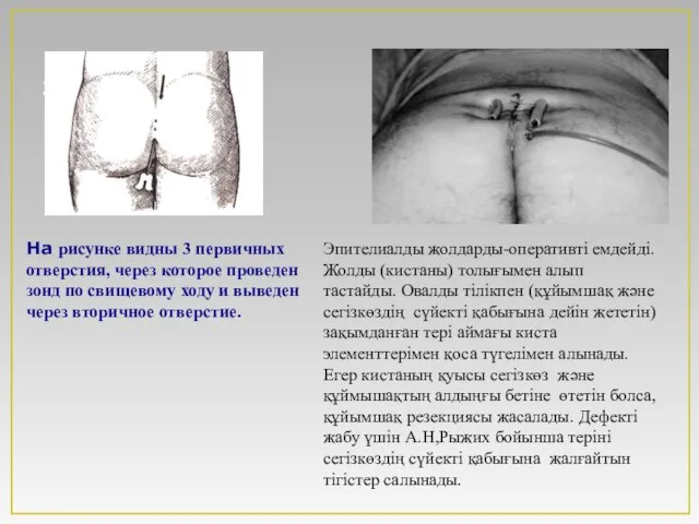 ээр На рисунке видны 3 первичных отверстия, через которое проведен зонд по